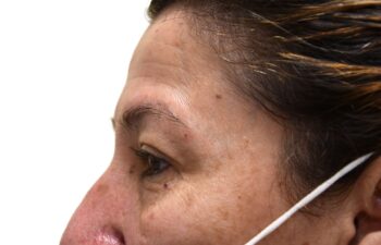 Before upper and lower blepharoplasty, left view of a female patient treated by Dr. Benjamin Eskenazi at Avabello Aesthetics in Miami Beach.