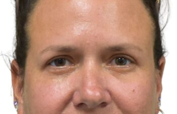 After upper and lower blepharoplasty, front view of a female patient treated by Dr. Benjamin Eskenazi at Avabello Aesthetics in Miami Beach.