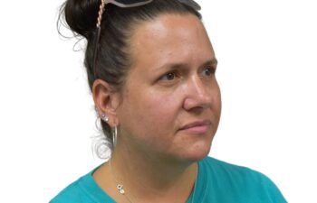 After upper and lower blepharoplasty, right oblique view of a female patient treated by Dr. Benjamin Eskenazi at Avabello Aesthetics in Miami Beach.