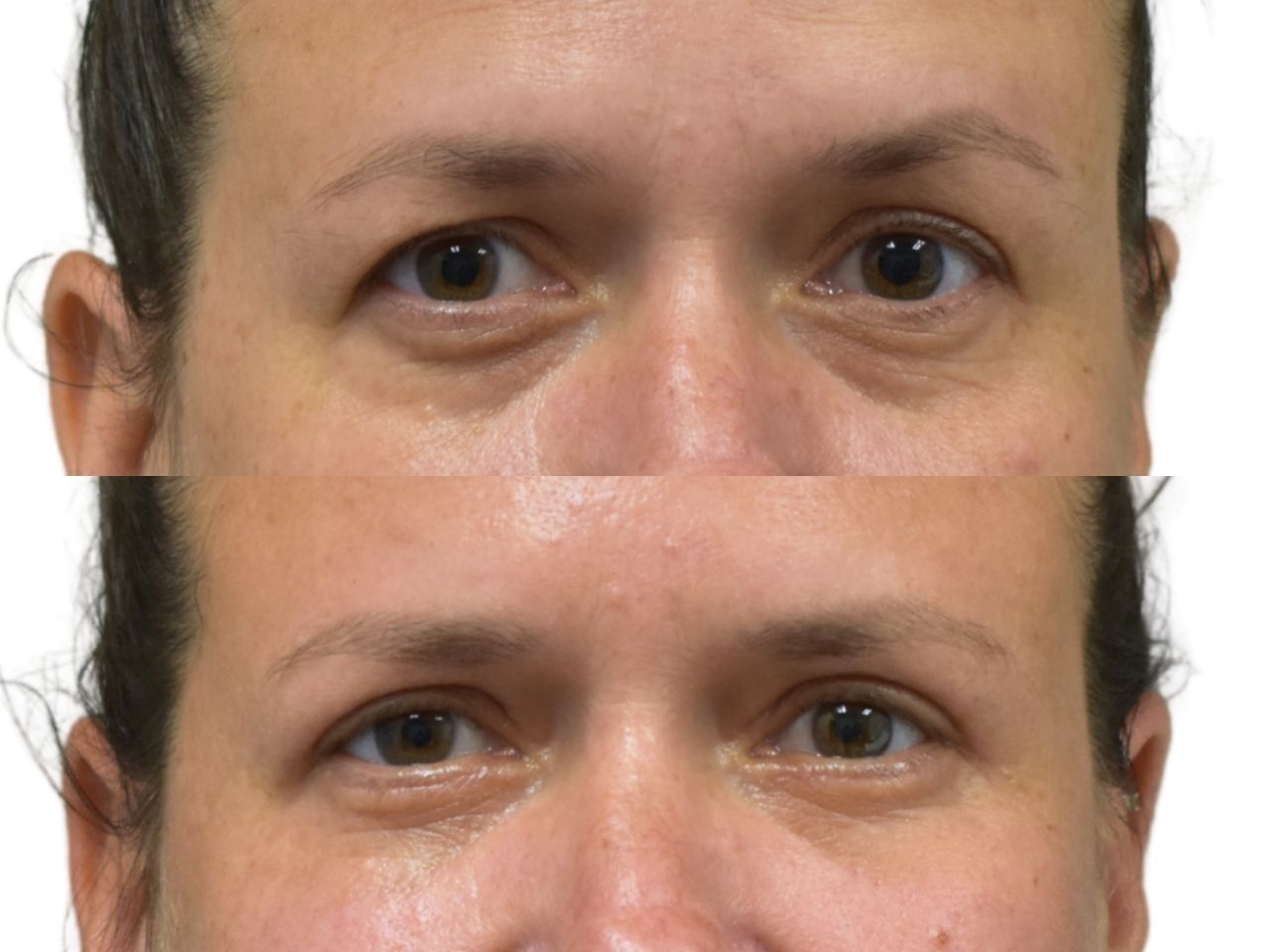 Before and after upper and lower blepharoplasty, front view of a female patient treated by Dr. Benjamin Eskenazi at Avabello Aesthetics in Miami Beach.