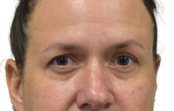 Before upper and lower blepharoplasty, front view of a female patient treated by Dr. Benjamin Eskenazi at Avabello Aesthetics in Miami Beach.