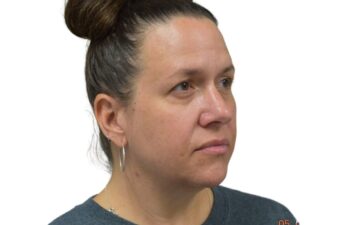 Before upper and lower blepharoplasty, right oblique view of a female patient treated by Dr. Benjamin Eskenazi at Avabello Aesthetics in Miami Beach.