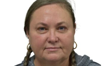 After upper and lower blepharoplasty, front view of a female patient treated by Dr. Benjamin Eskenazi at Avabello Aesthetics in Miami Beach.