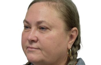 After upper and lower blepharoplasty, left oblique view of a female patient treated by Dr. Benjamin Eskenazi at Avabello Aesthetics in Miami Beach.