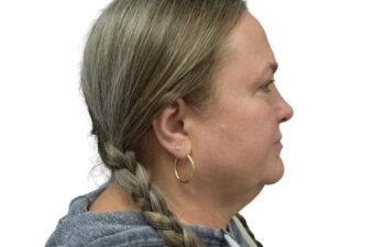 After upper and lower blepharoplasty, right view of a female patient treated by Dr. Benjamin Eskenazi at Avabello Aesthetics in Miami Beach.