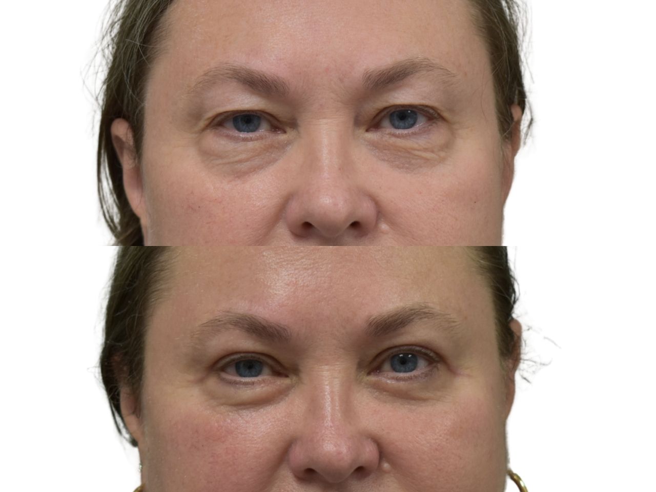 Before and after upper and lower blepharoplasty, front view of a female patient treated by Dr. Benjamin Eskenazi at Avabello Aesthetics in Miami Beach.