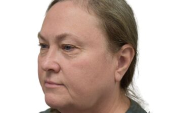 Before upper and lower blepharoplasty, left oblique view of a female patient treated by Dr. Benjamin Eskenazi at Avabello Aesthetics in Miami Beach.