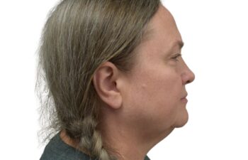 Before upper and lower blepharoplasty, right view of a female patient treated by Dr. Benjamin Eskenazi at Avabello Aesthetics in Miami Beach.