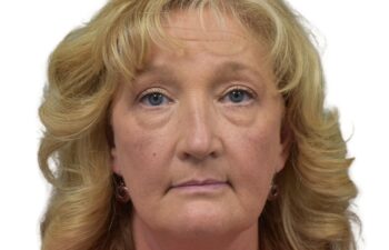 After upper and lower blepharoplasty, front view of a female patient treated by Dr. Benjamin Eskenazi at Avabello Aesthetics in Miami Beach.