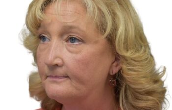 After upper and lower blepharoplasty, left oblique view of a female patient treated by Dr. Benjamin Eskenazi at Avabello Aesthetics in Miami Beach.