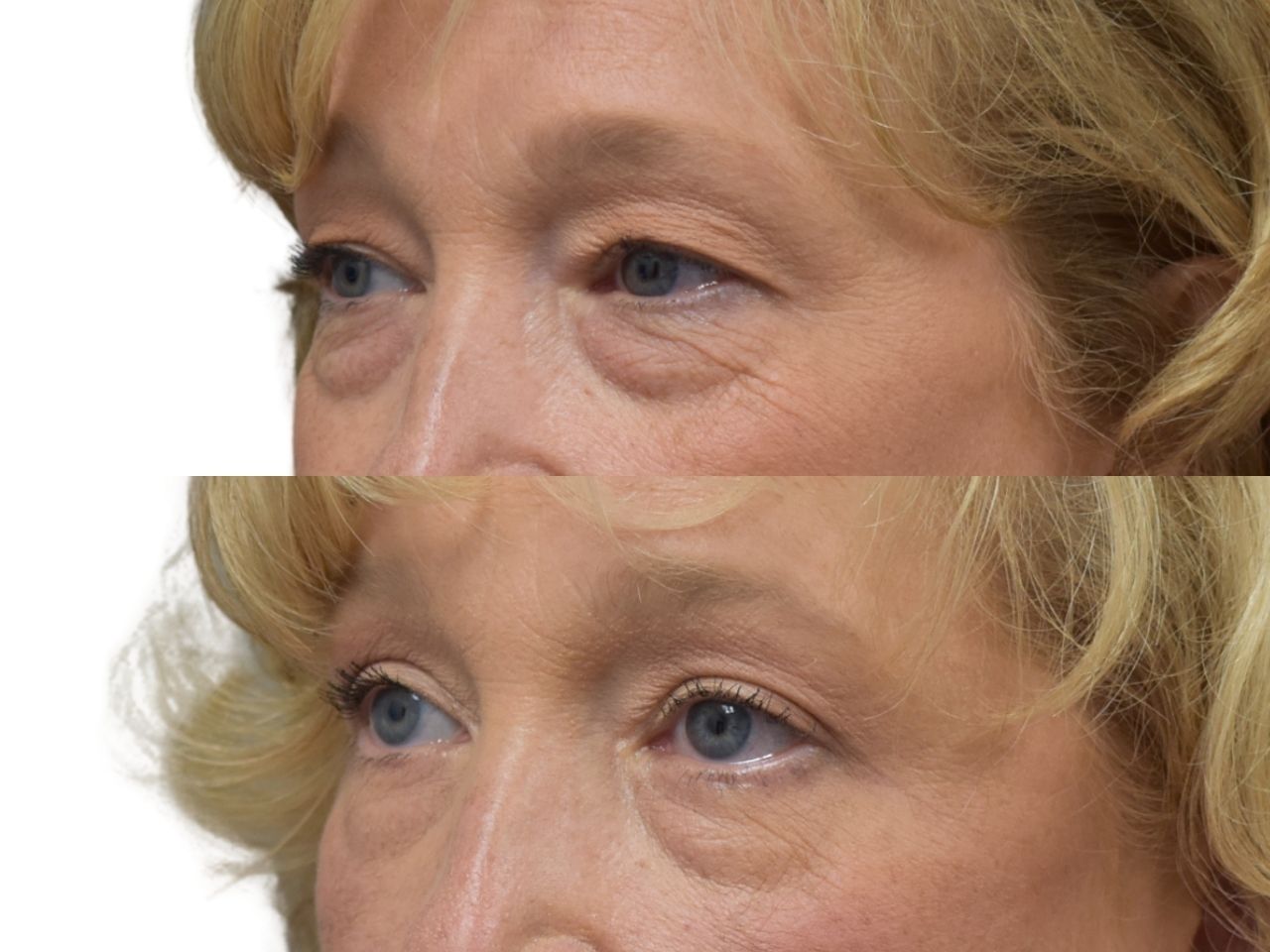 Before and after upper and lower blepharoplasty, left oblique view of a female patient treated by Dr. Benjamin Eskenazi at Avabello Aesthetics in Miami Beach.