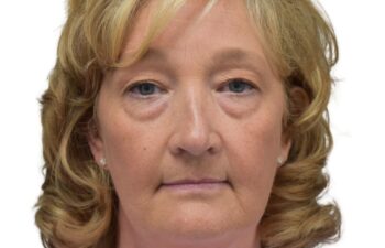 Before upper and lower blepharoplasty, front view of a female patient treated by Dr. Benjamin Eskenazi at Avabello Aesthetics in Miami Beach.