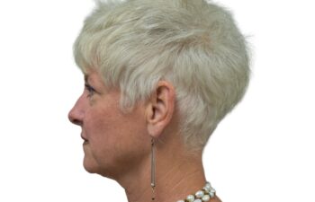 After upper blepharoplasty, left view of a female patient treated by Dr. Benjamin Eskenazi at Avabello Aesthetics in Miami Beach.