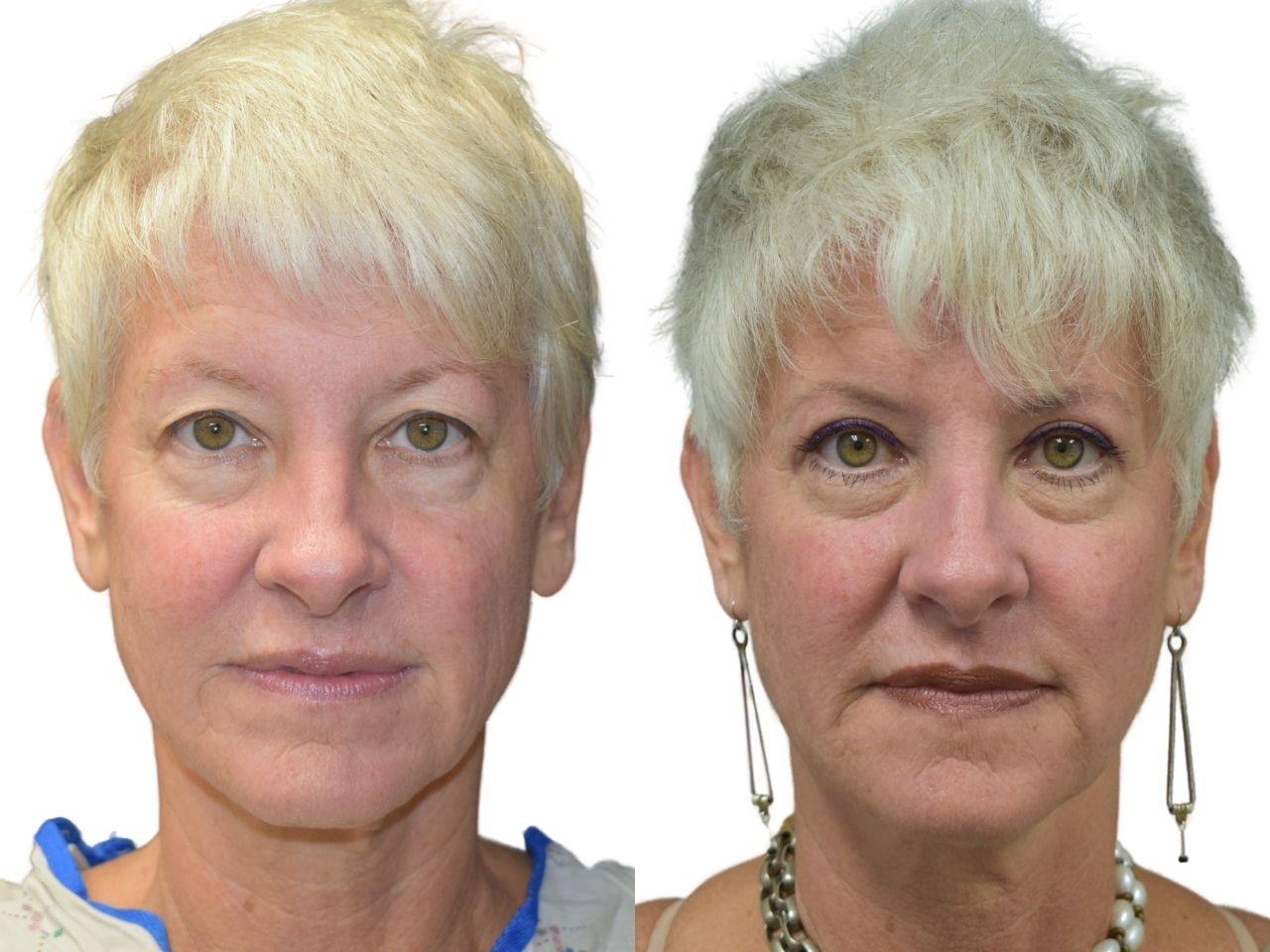 Before and after upper blepharoplasty, front view of a female patient treated by Dr. Benjamin Eskenazi at Avabello Aesthetics in Miami Beach.