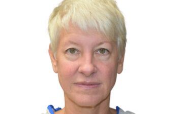 Before upper blepharoplasty, front view of a female patient treated by Dr. Benjamin Eskenazi at Avabello Aesthetics in Miami Beach.