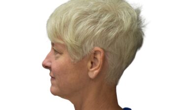 Before upper blepharoplasty, left view of a female patient treated by Dr. Benjamin Eskenazi at Avabello Aesthetics in Miami Beach.