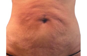 Primer plano del abdomen desnudo de una persona en el que se aprecian estrías y algo de piel flácida, con el ombligo en el centro.