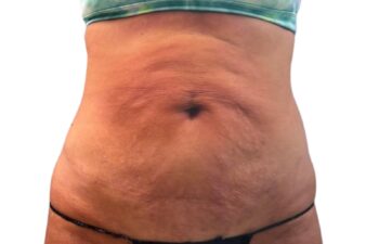 Un primer plano de la zona media del cuerpo de una persona, en el que se aprecia piel flácida y estrías en el abdomen; la persona lleva un top corto y ropa interior.