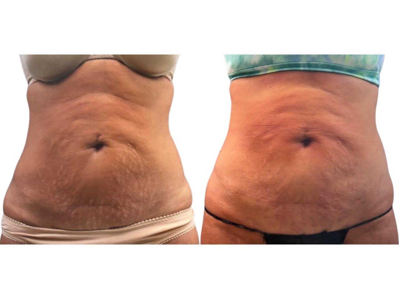 Before and after photos showing a woman's midsection with visible changes in skin texture and contour, likely due to a cosmetic or medical procedure.