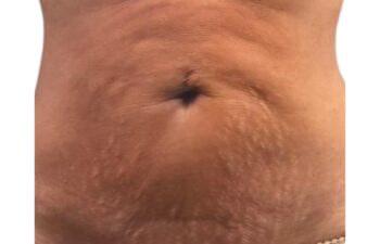 Primer plano de la zona abdominal de una persona en el que se aprecian estrías y piel flácida alrededor del ombligo.