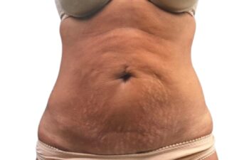 Un primer plano de la zona media del cuerpo de una mujer en el que se aprecia piel flácida y estrías en el abdomen; lleva un sujetador y ropa interior de color beige, sobre un fondo blanco.